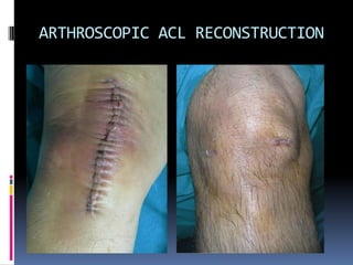 ARTHROSCOPIC ACL RECONSTRUCTION

 
