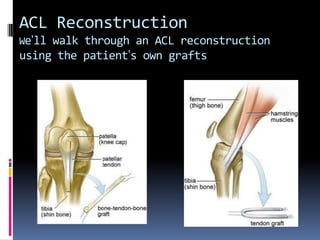 ACL Reconstruction
We’ll walk through an ACL reconstruction

using the patient’s own grafts

 