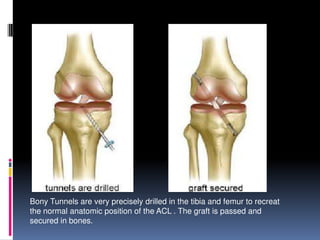 Bony Tunnels are very precisely drilled in the tibia and femur to recreat
the normal anatomic position of the ACL . The graft is passed and
secured in bones.

 