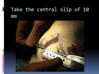 Take the central slip of 10
mm

 