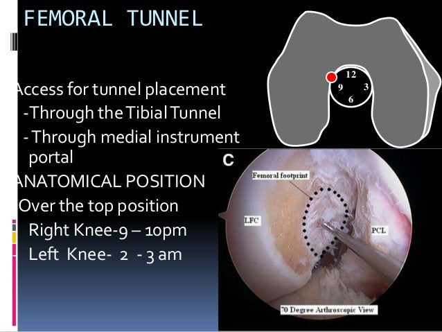 Acl Reconstruction Surgery In Delhi Dr. Shekhar Srivastav 09971192233