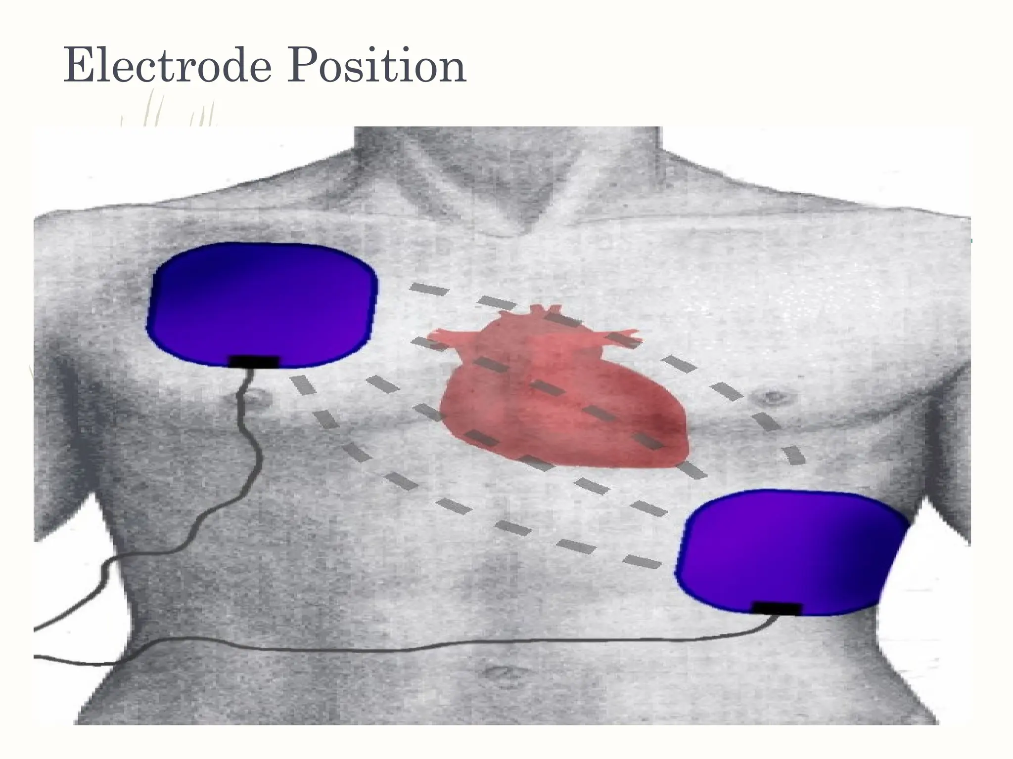 Electrode Position
 