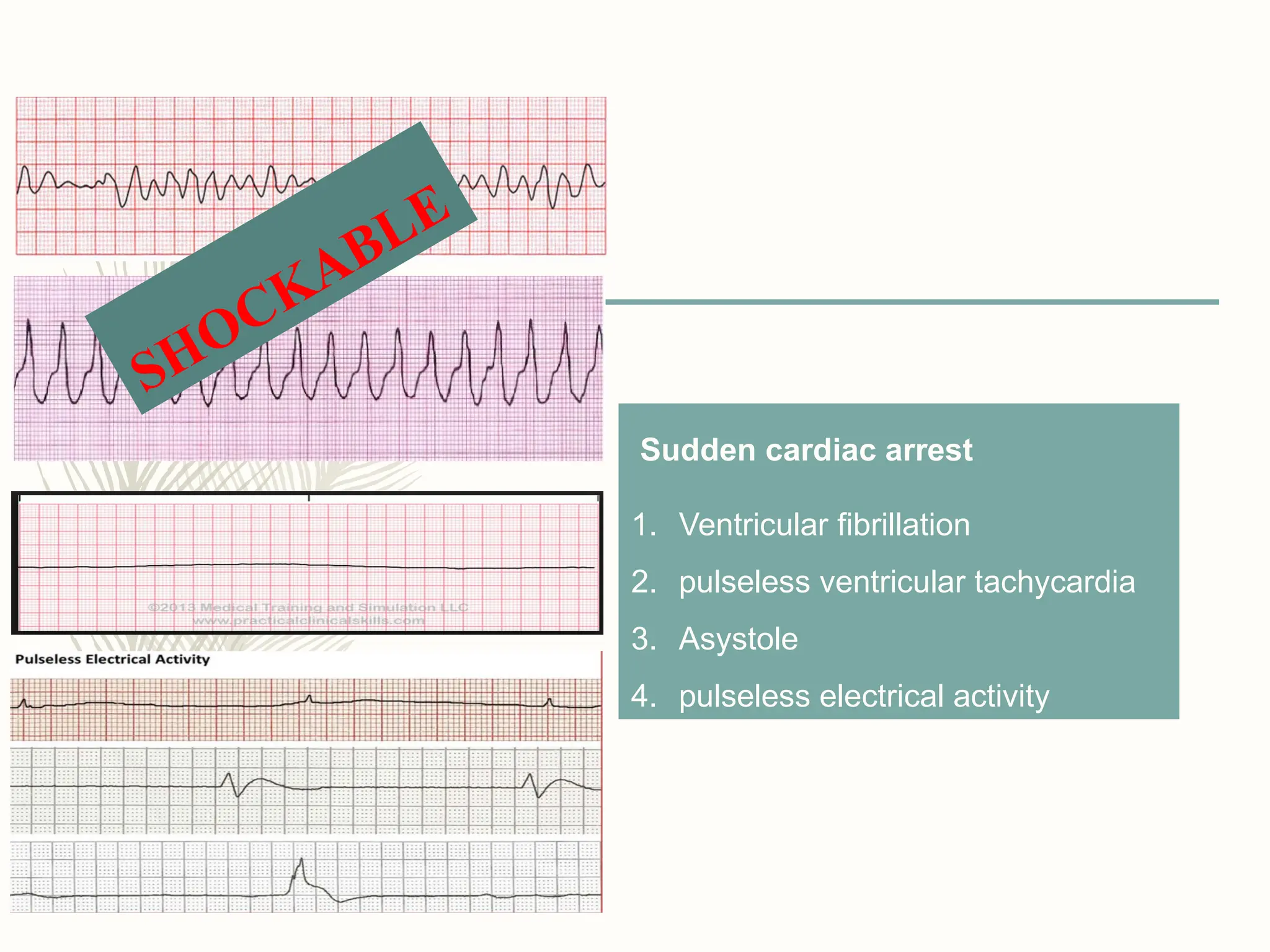 Sudden cardiac arrest
1. Ventricular fibrillation
2. pulseless ventricular tachycardia
3. Asystole
4. pulseless electrical activity
SHOCKABLE
 