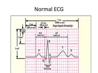 Normal ECG
 