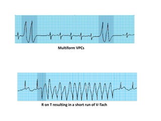 Multiform VPCs
R on T resulting in a short run of V-Tach
 