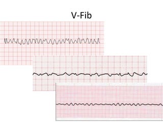 V-Fib
 