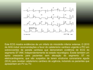 Este ECG mostra evidências de um infarto do miocárdio inferior extensa. O 2010
da AHA incluir recomendações a favor do cateterismo cardíaco urgente e PCI em
sobreviventes de parada cardíaca que demonstram evidência de ECG do
segmento ST IAM, independentemente do estado neurológico. Existe também um
apoio crescente para pacientes sem elevação do segmento ST no
eletrocardiograma, que são suspeitos de terem síndrome coronariana aguda
(SCA) para receber cateterismo cardíaco de urgência, incluindo os pacientes que
apresentam em FV ou TV.
 