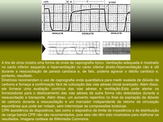 A tira de cima mostra uma forma de onda de capnografia típico. Ventilação adequada é mostrado
no canto inferior esquerdo e hiperventilação no canto inferior direito.Hiperventilação não é útil
durante a ressuscitação de parada cardíaca e, de fato, poderia agravar o débito cardíaco e,
portanto, resultado.
Diretrizes recomendam o uso de capnografia onda quantitativa para medir exalada de dióxido de
carbono e forneça a confirmação fácil de colocação das vias aéreas inicial avançado. Além disso,
ele fornece uma avaliação contínua das vias aéreas e ventilação.Esta pode alertar os
fornecedores para o deslocamento das vias aéreas de outra forma não detectados durante a
ressuscitação e transporte. Além disso, um aumento repentino no final da expiração de dióxido
de carbono durante a ressuscitação é um marcador independente de retorno da circulação
espontânea que pode ser notado, sem interromper as compressões torácicas.
CPR assistência de dispositivos, tais como o dispositivo de limite de impedância e de distribuição
de carga banda CPR não são recomendados, pois eles não têm sido mostrados para melhorar os
resultados. Imagens cortesia de Wikimedia Commons.
 