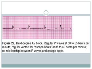 Adult cardiac life support(ACLS) | PPTX