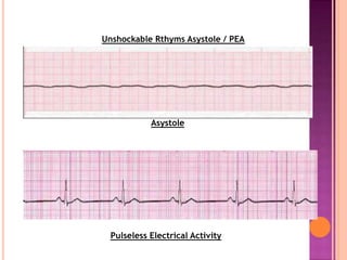 Unshockable Rthyms Asystole / PEA
Asystole
Pulseless Electrical Activity
 