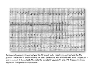 Paroxysmal supraventricular tachycardia. Atrioventricular nodal reentrant tachycardia. The 
paFent's heart rate is approximately 146 beats per minute with a normal axis. Note the pseudo S 
waves in leads II, III, and aVF. Also note the pseudo R' waves in V1 and aVR. These deﬂecFons 
represent retrograde atrial acFvaFon. 
 