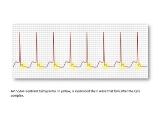 AV nodal reentrant tachycardia. In yellow, is evidenced the P wave that falls aLer the QRS 
complex. 
 