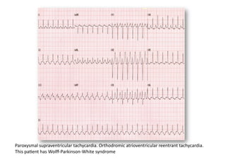 Paroxysmal supraventricular tachycardia. Orthodromic atrioventricular reentrant tachycardia. 
This paFent has Wolﬀ‐Parkinson‐White syndrome 
 