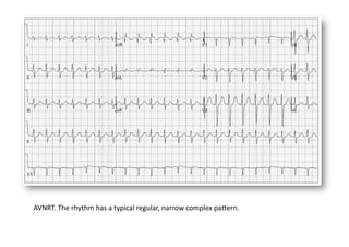 AVNRT. The rhythm has a typical regular, narrow complex papern. 
 