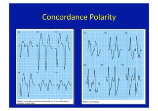 Concordance Polarity 
 