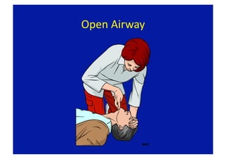 Open Airway 
 
