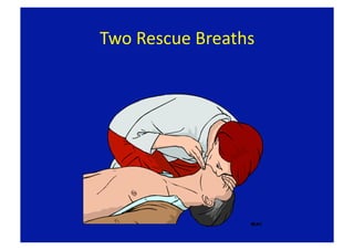Two Rescue Breaths 
 