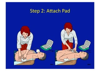 Step 2: Apach Pad 
 