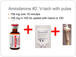 Amiodarone #2: V-tach with pulse
 150 mg over 10 minutes
 150 mg in 100 mL spiked with macro is 100
gtt/min
 