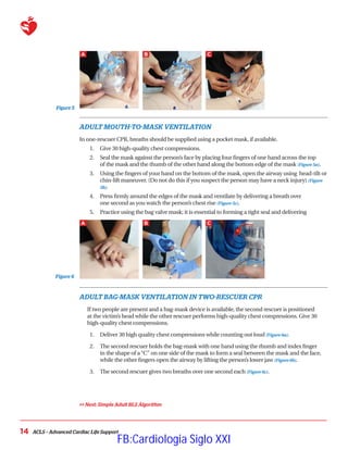 ACLS – Advanced Cardiac Life Support
14
Figure 5
ADULT MOUTH-TO-MASK VENTILATION
In one-rescuer CPR, breaths should be supplied using a pocket mask, if available.
1.	 Give 30 high-quality chest compressions.
2.	 
Seal the mask against the person’s face by placing four fingers of one hand across the top
of the mask and the thumb of the other hand along the bottom edge of the mask (Figure 5a).
3.	 
Using the fingers of your hand on the bottom of the mask, open the airway using head-tilt or
chin-lift maneuver. (Do not do this if you suspect the person may have a neck injury) (Figure
5b).
4.	 
Press firmly around the edges of the mask and ventilate by delivering a breath over
one second as you watch the person’s chest rise (Figure 5c).
5.	 
Practice using the bag valve mask; it is essential to forming a tight seal and delivering
ADULT BAG-MASK VENTILATION IN TWO-RESCUER CPR
If two people are present and a bag-mask device is available, the second rescuer is positioned
at the victim’s head while the other rescuer performs high-quality chest compressions. Give 30
high-quality chest compressions.
1.	 Deliver 30 high quality chest compressions while counting out loud (Figure 6a).
2.	 
The second rescuer holds the bag-mask with one hand using the thumb and index finger
in the shape of a“C” on one side of the mask to form a seal between the mask and the face,
while the other fingers open the airway by lifting the person’s lower jaw (Figure 6b).
3.	 The second rescuer gives two breaths over one second each (Figure 6c).
 Next: Simple Adult BLS Algorithm
Figure 6
A B C
A B C
FB:Cardiologia Siglo XXI
 