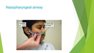 Nasopharyngeal airway
 