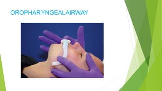 OROPHARYNGEALAIRWAY
 