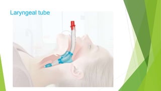 Laryngeal tube
 