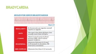 BRADYCARDIA
 