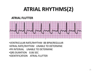 ACLS CE -Part I of III -ECG STRIP INTERPRETATION w Case Scenarios ...