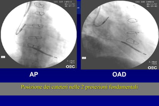 Posizione dei cateteri nelle 2 proiezioni fondamentaliPosizione dei cateteri nelle 2 proiezioni fondamentali
AP OAD
 