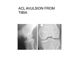 Radiographic evaluation
MRI
Secondary signs:
 Those alert attention to ACL tear
 Lateral femoral condyle contusion
 Ant...