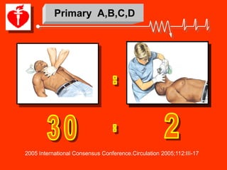 Primary A,B,C,D




2005 International Consensus Conference.Circulation 2005;112:III-17
 