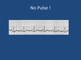 No Pulse !
 