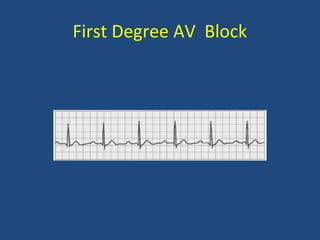 First Degree AV Block
 