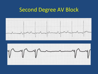 Second Degree AV Block
 