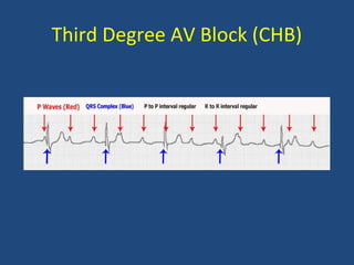 Third Degree AV Block (CHB)
 