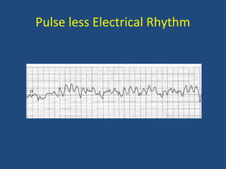 Pulse less Electrical Rhythm
 