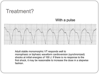 Treatment?
With a pulse

Adult stable monomorphic VT responds well to
monophasic or biphasic waveform cardioversion (synchronized)
shocks at initial energies of 100 J. If there is no response to the
first shock, it may be reasonable to increase the dose in a stepwise
fashion.

 