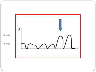 40 mmHg

15 mmHg

 
