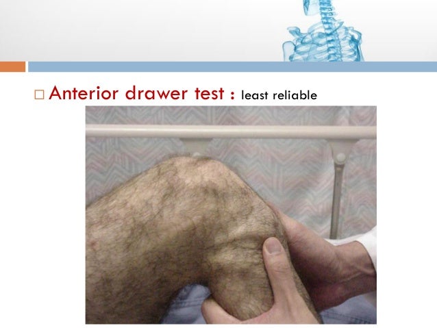 Acl Tear