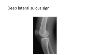 Deep lateral sulcus sign
 
