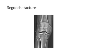 Segonds fracture
 