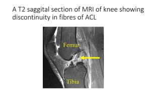 A T2 saggital section of MRI of knee showing
discontinuity in fibres of ACL
 