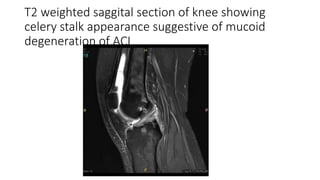 T2 weighted saggital section of knee showing
celery stalk appearance suggestive of mucoid
degeneration of ACL
 