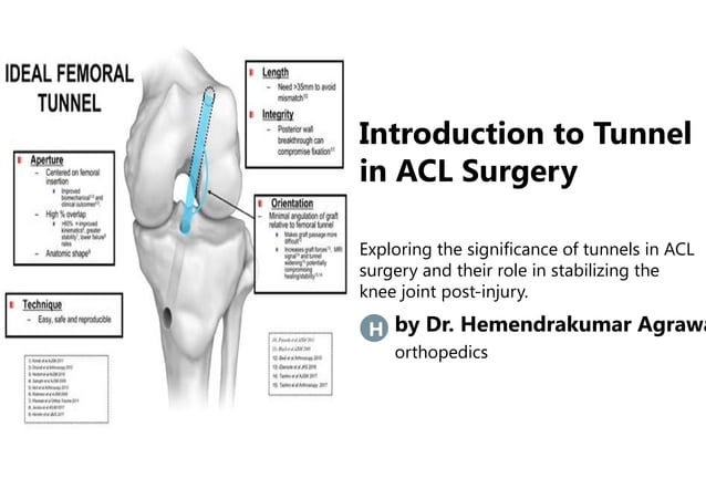 ACL TUNNEL for knee ligamnet surgery.pptx