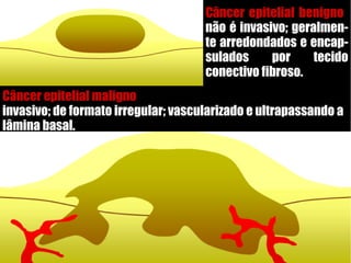 Câncer epitelial benigno
não é invasivo; geralmen-
te arredondados e encap-
sulados por tecido
conectivo fibroso.
Câncer epitelial maligno
invasivo; de formato irregular; vascularizado e ultrapassando a
lâmina basal.
 