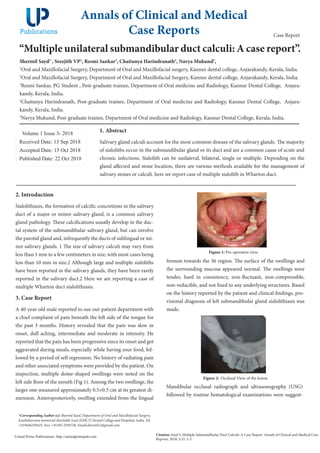 “Multiple unilateral submandibular duct calculi: A case report”.
Shermil Sayd1*
, Sreejith VP2
, Resmi Sankar3
, Chaitanya Harindranath4
, Navya Mukund5
,
1
Oral and Maxillofacial Surgery, Department of Oral and Maxillofacial surgery, Kannur dental college, Anjarakandy, Kerala, India.
2
Oral and Maxillofacial Surgery, Department of Oral and Maxillofacial Surgery, Kannur dental college, Anjarakandy, Kerala, India.
3
Resmi Sankar, PG Student , Post-graduate trainee, Department of Oral medicine and Radiology, Kannur Dental College, Anjara-
kandy, Kerala, India.
4
Chaitanya Harindranath, Post-graduate trainee, Department of Oral medicine and Radiology, Kannur Dental College, Anjara-
kandy, Kerala, India.
5
Navya Mukund, Post-graduate trainee, Department of Oral medicine and Radiology, Kannur Dental College, Kerala, India.
Volume 1 Issue 3- 2018
Received Date: 15 Sep 2018
Accepted Date: 15 Oct 2018
Published Date: 22 Oct 2018
1. Abstract
Salivary gland calculi account for the most common disease of the salivary glands. The majority
of sialoliths occur in the submandibular gland or its duct and are a common cause of acute and
chronic infections. Sialolith can be unilateral, bilateral, single or multiple. Depending on the
gland affected and stone location, there are various methods available for the management of
salivary stones or calculi. here we report case of multiple sialolith in Wharton duct.
Annals of Clinical and Medical
Case Reports
Citation: Sayd S, Multiple Submandibular Duct Calculi: A Case Report. Annals of Clinical and Medical Case
Reports. 2018; 1(3): 1-3.
United Prime Publications: http://unitedprimepub.com
*Corresponding Author (s): Shermil Sayd, Department of Oral and Maxillofacial Surgery,
Kunhitharuvai memorial charitable trust (KMCT) Dental College and Hospitals, India, Tel:
+919446230425; Fax: +91495 2294726; Email:shermil12@gmail.com
Case Report
2. Introduction
Sialolithiasis, the formation of calcific concretions in the salivary
duct of a major or minor salivary gland, is a common salivary
gland pathology. These calcifications usually develop in the duc-
tal system of the submandibular salivary gland, but can involve
the parotid gland and, infrequently the ducts of sublingual or mi-
nor salivary glands. 1 The size of salivary calculi may vary from
less than 1 mm to a few centimeters in size, with most cases being
less than 10 mm in size.2 Although large and multiple sialoliths
have been reported in the salivary glands, they have been rarely
reported in the salivary duct.2 Here we are reporting a case of
multiple Wharton duct sialolithiasis.
3. Case Report
A 40-year-old male reported to our out-patient department with
a chief complaint of pain beneath the left side of the tongue for
the past 3 months. History revealed that the pain was slow in
onset, dull aching, intermediate and moderate in intensity. He
reported that the pain has been progressive since its onset and got
aggravated during meals, especially while having sour food, fol-
lowed by a period of self regression. No history of radiating pain
and other associated symptoms were provided by the patient. On
inspection, multiple dome-shaped swellings were noted on the
left side floor of the mouth (Fig 1). Among the two swellings, the
larger one measured approximately 0.5×0.5 cm at its greatest di-
mension. Anteroposteriorly, swelling extended from the lingual
Figure 1: Pre-operative view.
frenum towards the 36 region. The surface of the swellings and
the surrounding mucosa appeared normal. The swellings were
tender, hard in consistency, non-fluctuant, non-compressible,
non-reducible, and not fixed to any underlying structures. Based
on the history reported by the patient and clinical findings, pro-
visional diagnosis of left submandibular gland sialolithiasis was
made.
Figure 2: Occlusal View of the lesion.
Mandibular occlusal radiograph and ultrasonography (USG)
followed by routine hematological examinations were suggest-
 