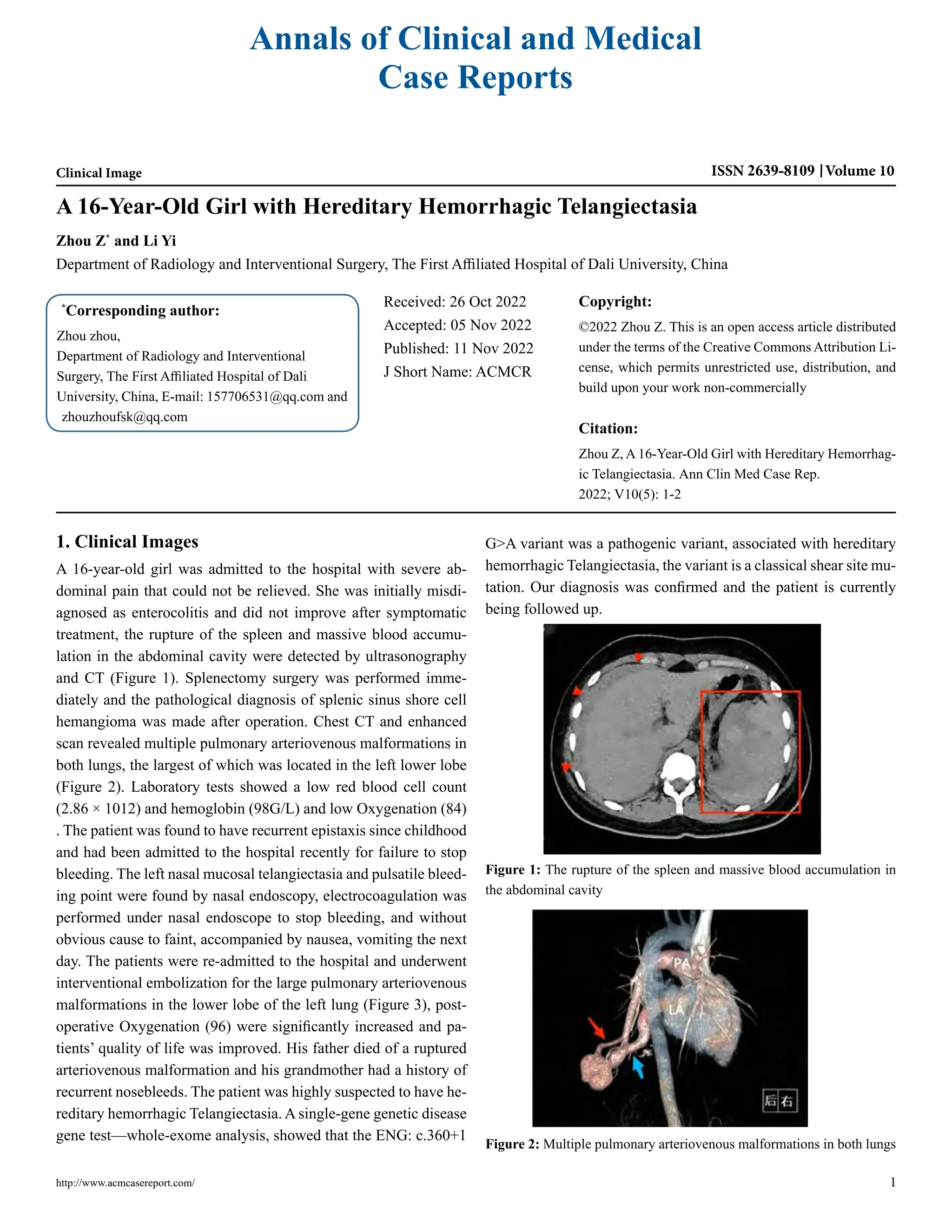 A 16-Year-Old Girl with Hereditary Hemorrhagic Telangiectasia | PDF