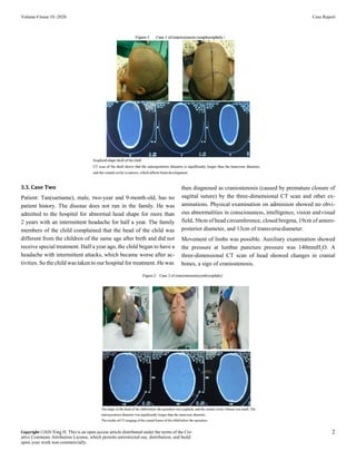 Volume 4 Issue 10 -2020 Case Report
3.3. Case Two
Patient: Tan(surname), male, two-year and 9-month-old, has no
patient hi...