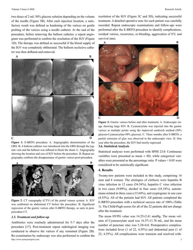 Safety and Efficacy of Modified BRTOAssisted Endoscopic Cyanoacrylate